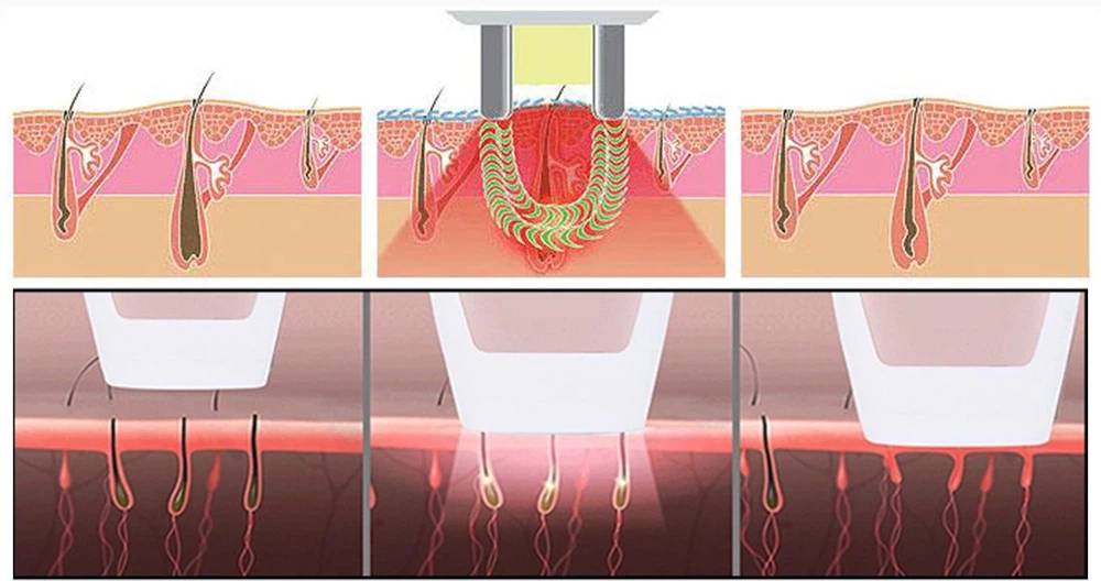 Shr Laser Hair Removal Machine Shr Laser Hair Removal Machine